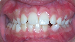 Dental Midlines at Optimal Orthodontics of Humble in Humble TX