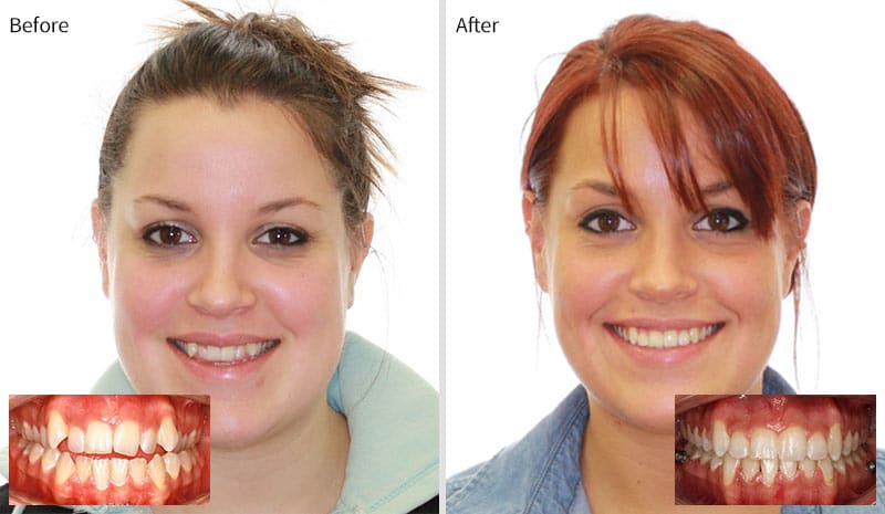Before After 1 at Optimal Orthodontics of Humble in Humble TX