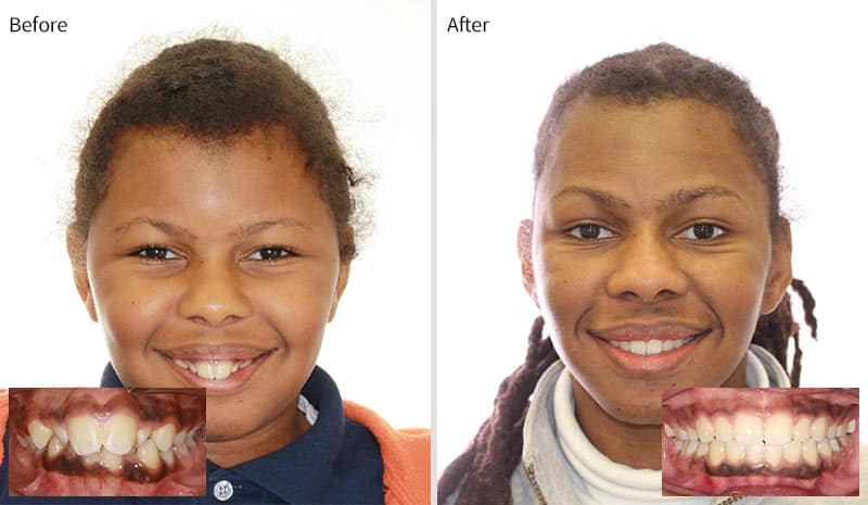 Before After 2 at Optimal Orthodontics of Humble in Humble TX