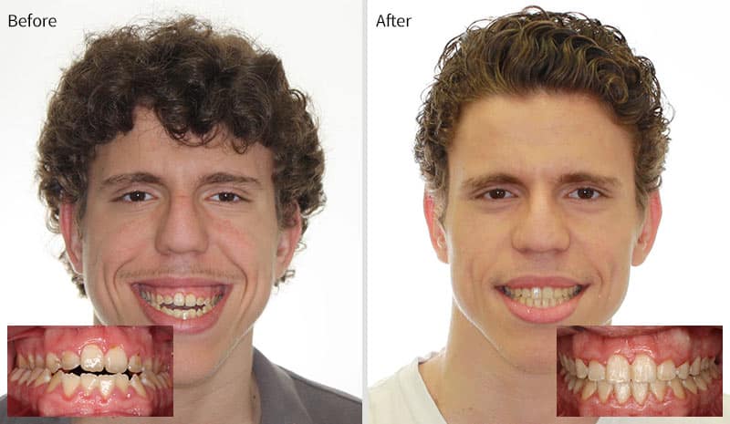 Before After 3 at Optimal Orthodontics of Humble in Humble TX