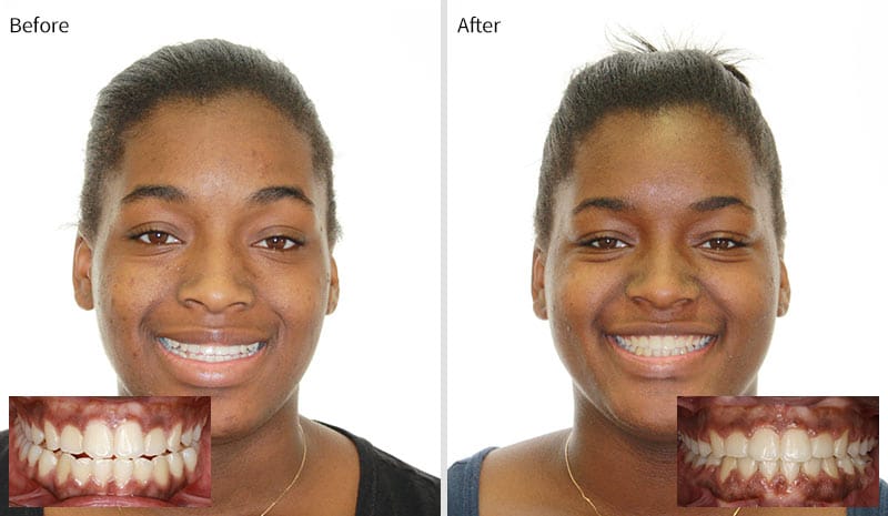 Before and After 4 at Optimal Orthodontics of Humble in Humble TX