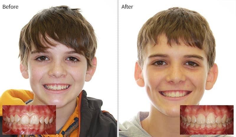Before After 5 at Optimal Orthodontics of Humble in Humble TX