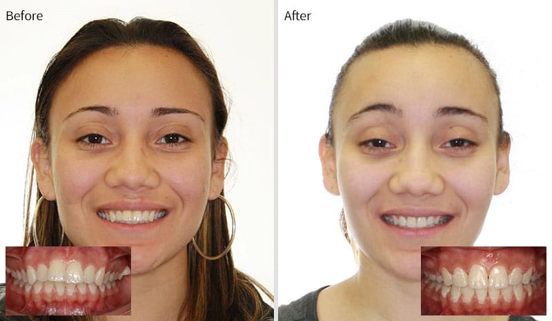Before After 6 at Optimal Orthodontics of Humble in Humble TX
