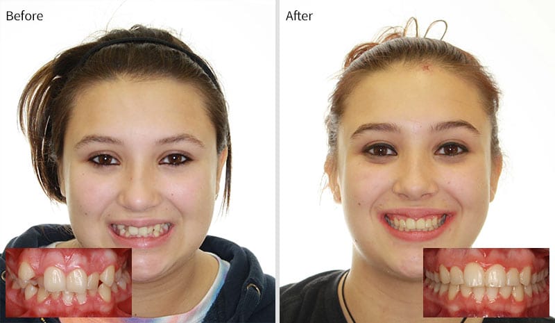 Before After 7 at Optimal Orthodontics of Humble in Humble TX